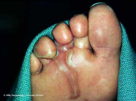 Larva migrans cutanée — trajet serpentant sur le pied