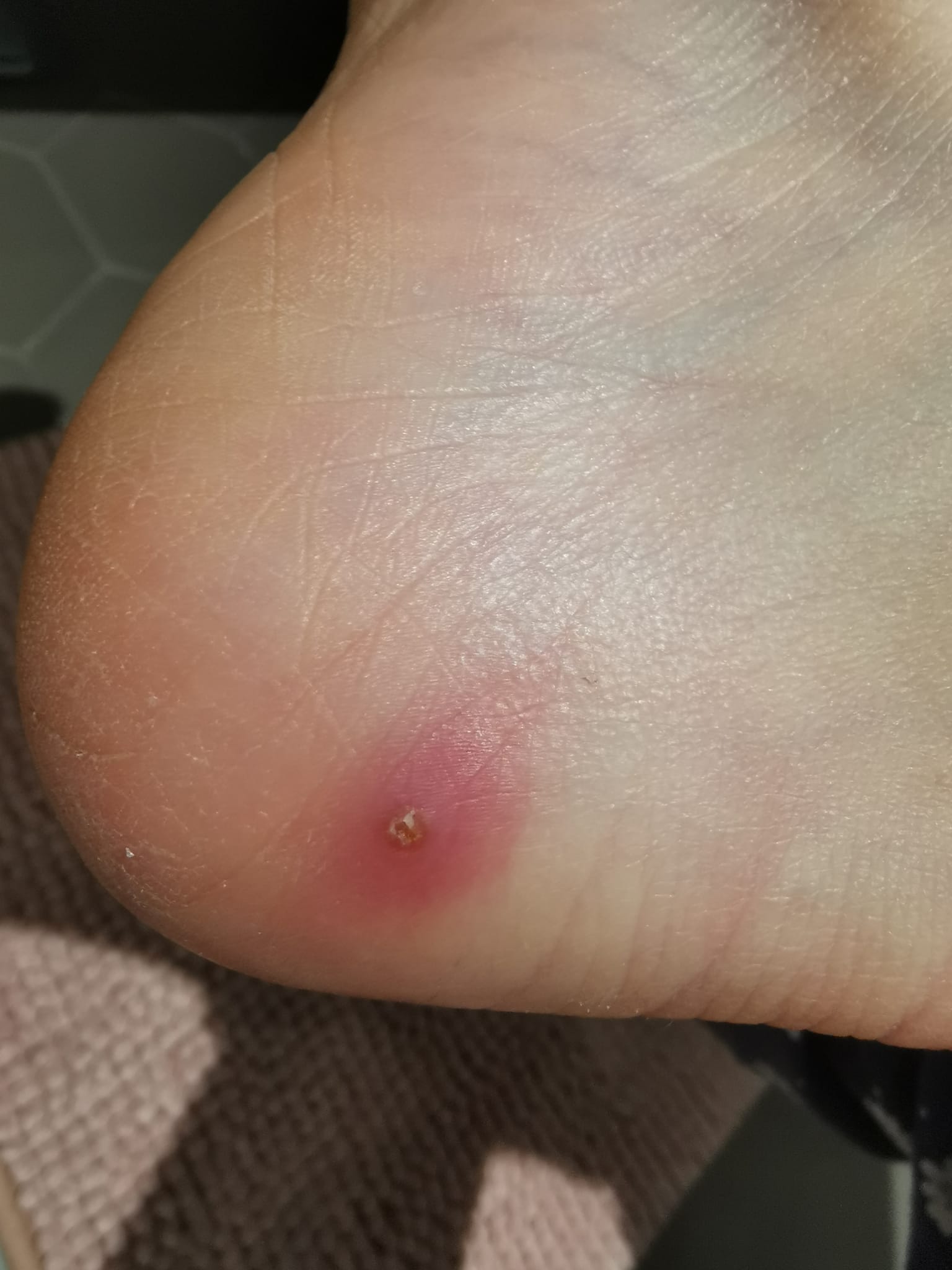 Myiase furonculaire — J1