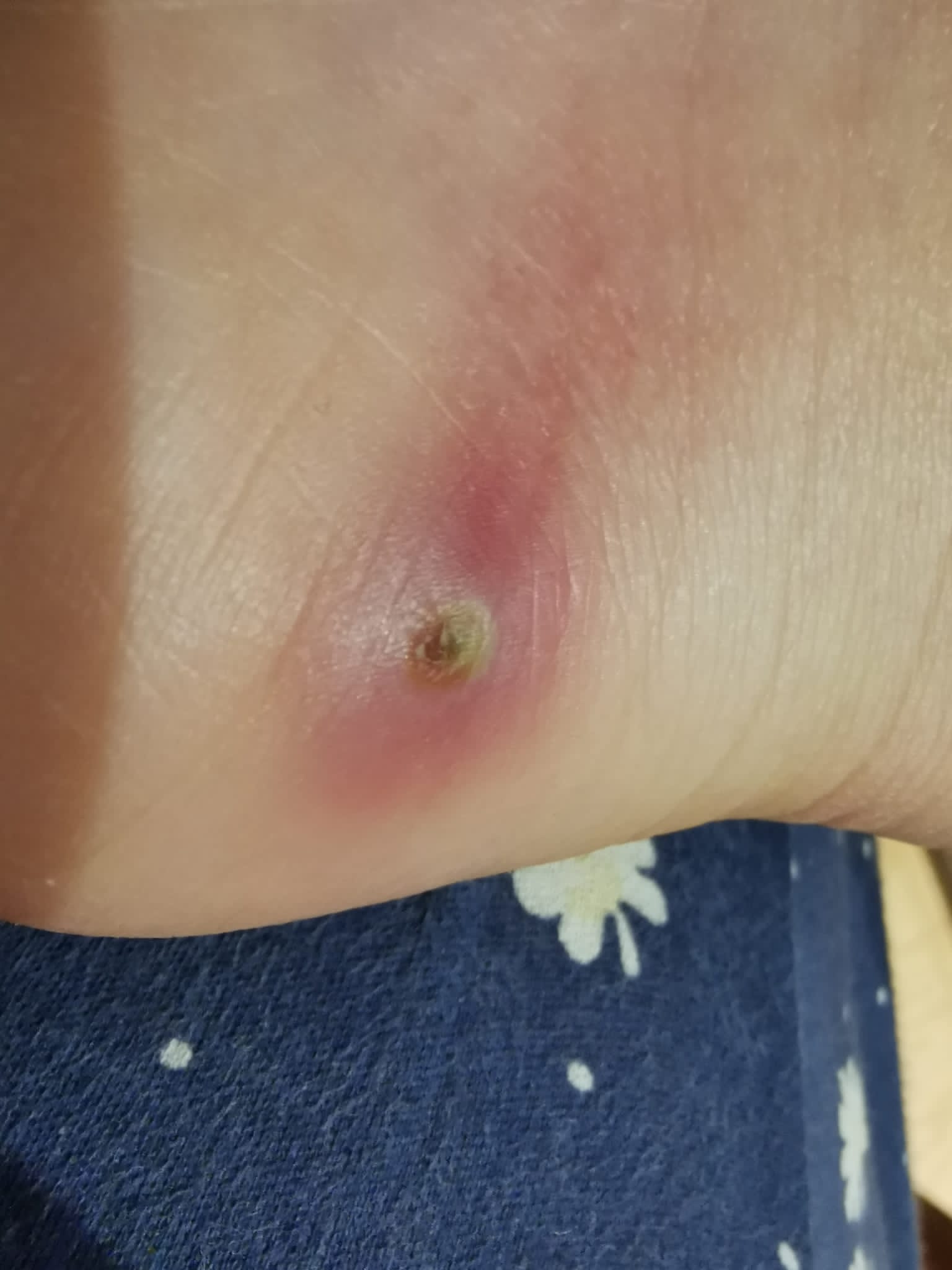 Myiase furonculaire — J4 post-extraction