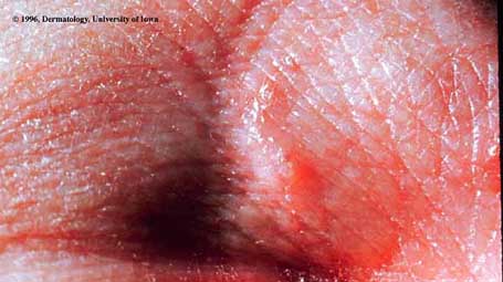 Gale — papules prurigineuses